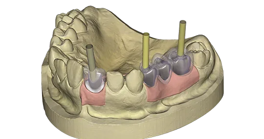 exocad - Implant Add On Module