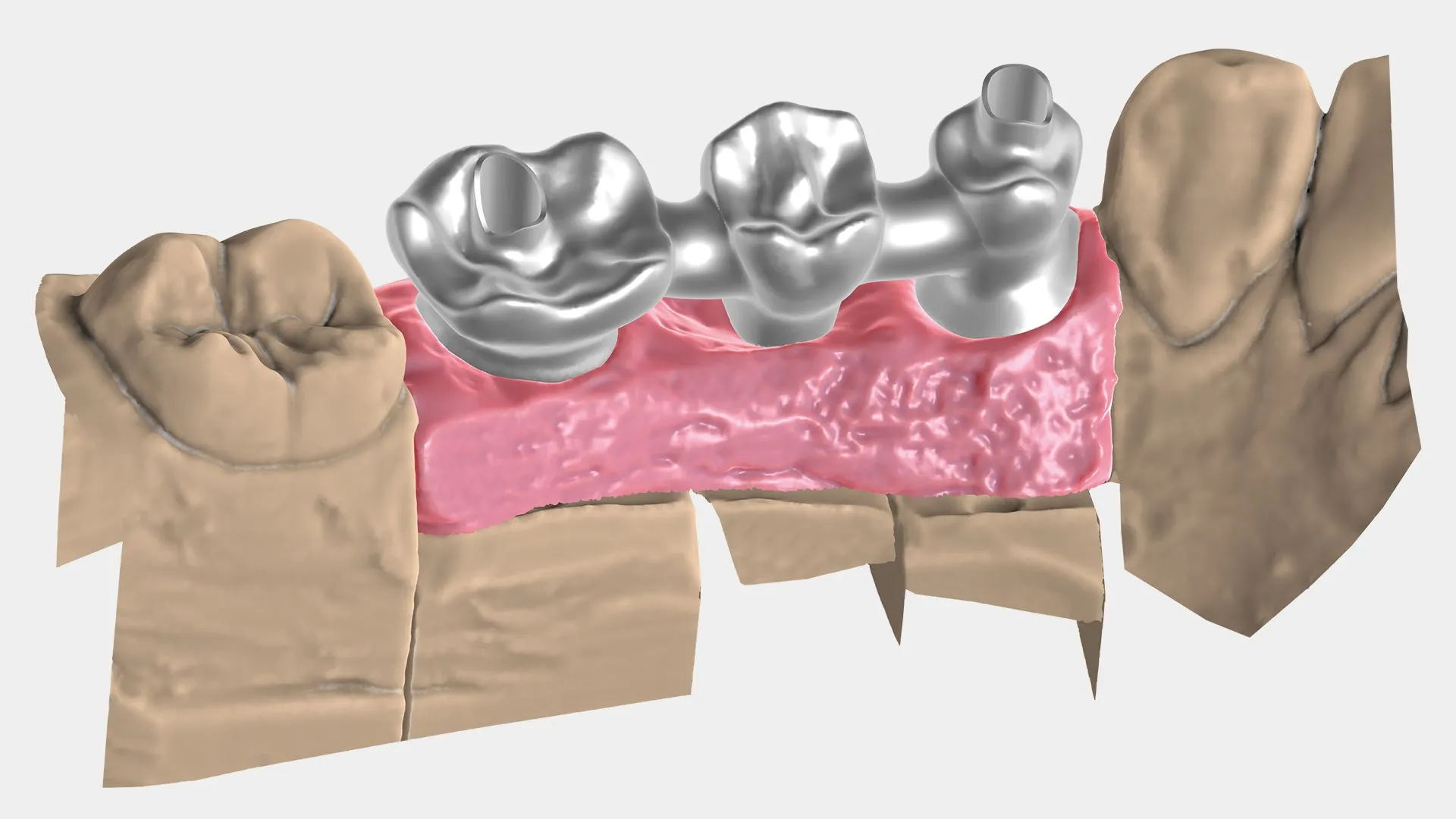 exocad - Implant Add On Module