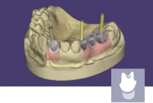 exocad - Implant Add On Module